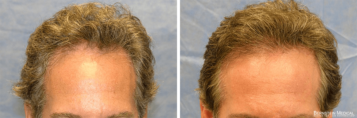Bernstein Medical - Patient FBL Before and After Hair Transplant Photo 