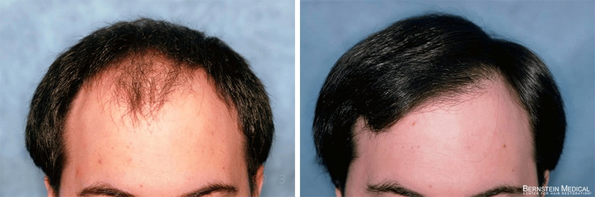Bernstein Medical - Patient FEI Before and After Hair Transplant Photo 