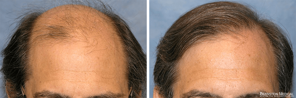 Bernstein Medical - Patient FKQ Before and After Hair Transplant Photo 