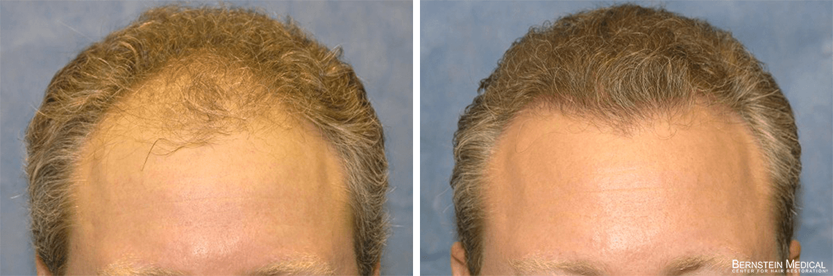 Bernstein Medical - Patient FMI Before and After Hair Transplant Photo 