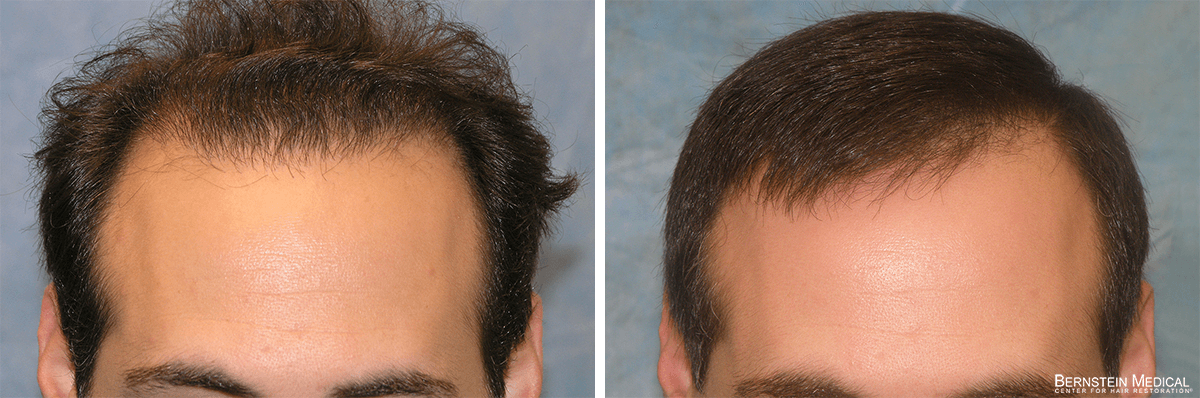 Bernstein Medical - Patient FTC Before and After Hair Transplant Photo 