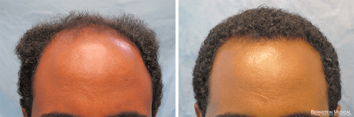 Bernstein Medical - Patient FZE Before and After Hair Transplant Photo 