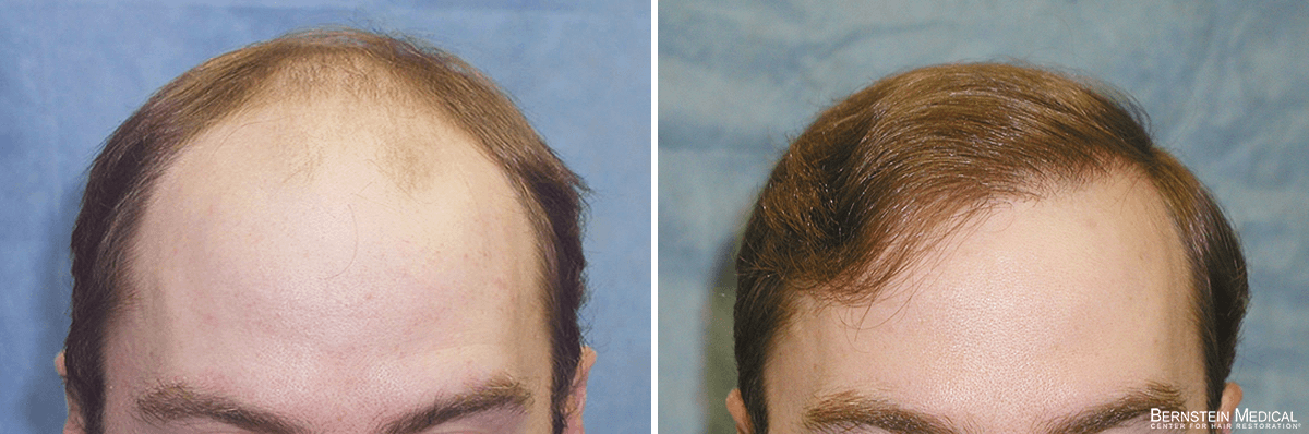 Bernstein Medical - Patient GJK Before and After Hair Transplant Photo 