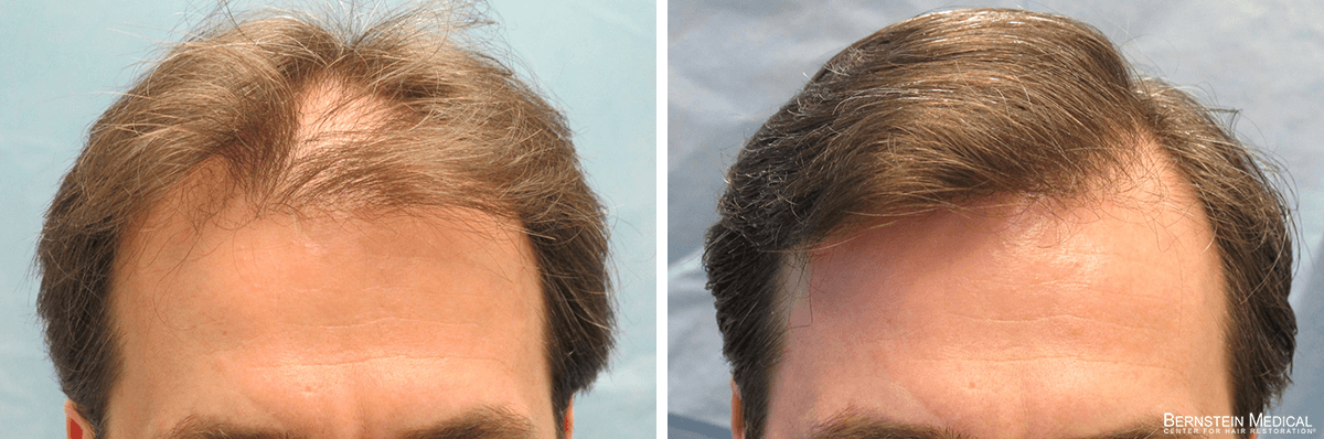 Bernstein Medical - Patient GLI Before and After Hair Transplant Photo 