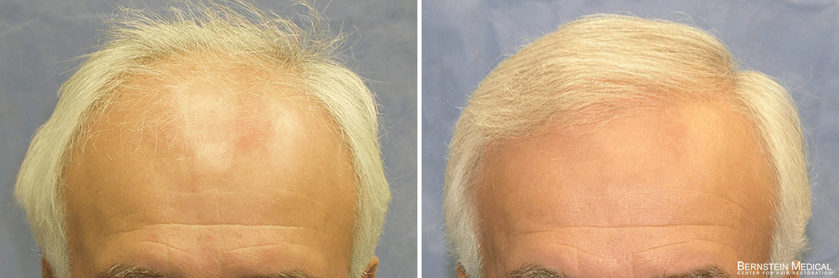 Bernstein Medical - Patient GLQ Before and After Hair Transplant Photo 