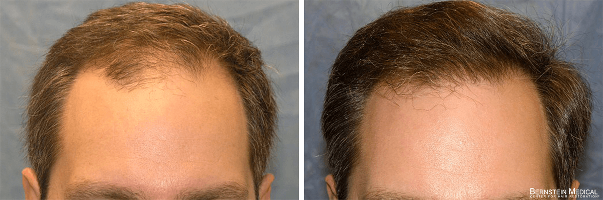 Bernstein Medical - Patient GNO Before and After Hair Transplant Photo 