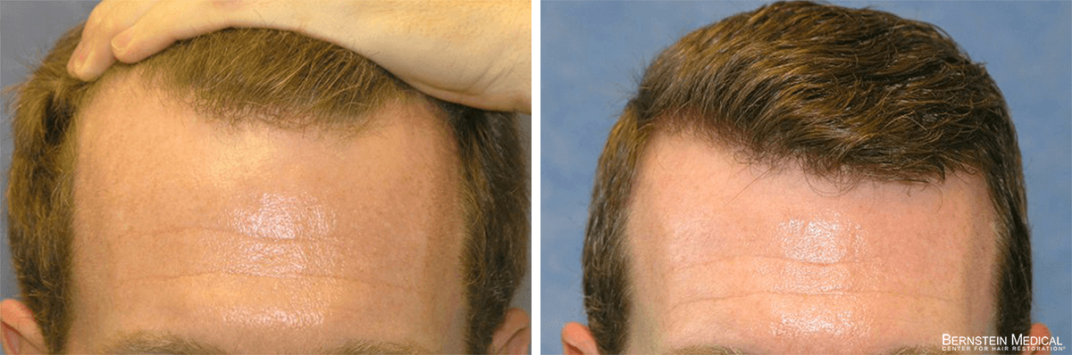 Bernstein Medical - Patient GPI Before and After Hair Transplant Photo 