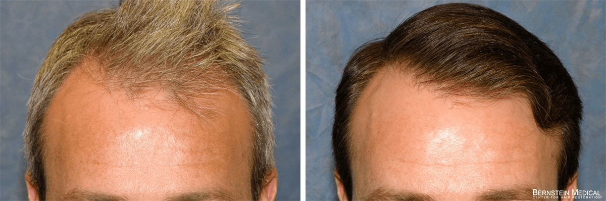 Bernstein Medical - Patient GTZ Before and After Hair Transplant Photo 