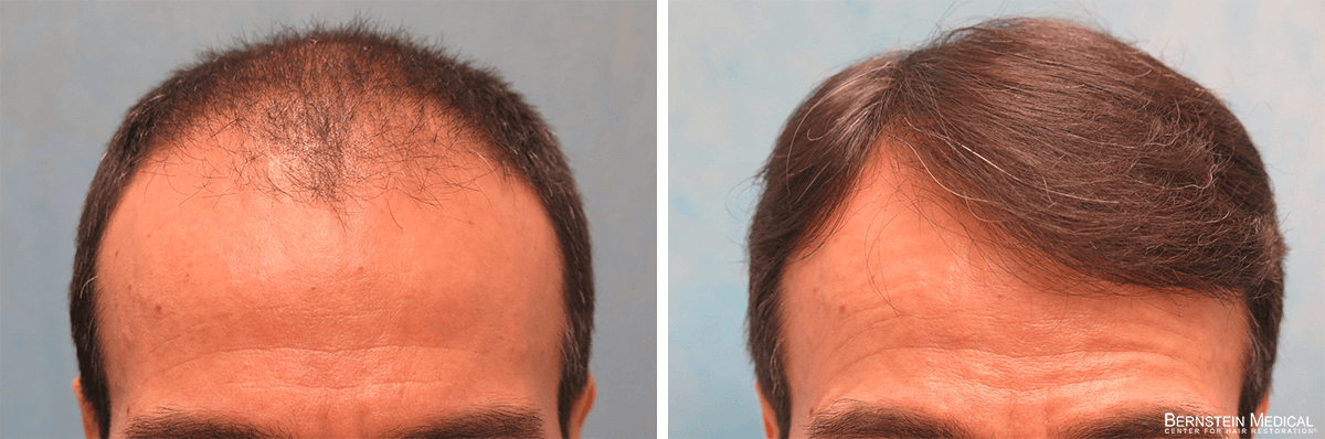 Bernstein Medical - Patient HLE Before and After Hair Transplant Photo 
