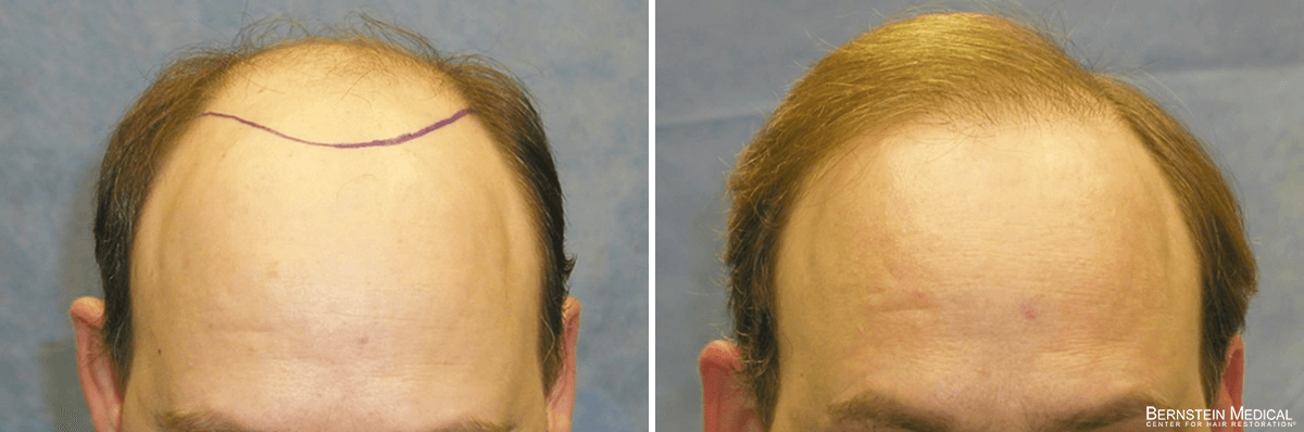 Bernstein Medical - Patient HMO Before and After Hair Transplant Photo 