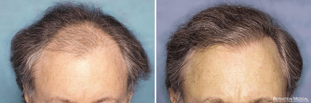 Bernstein Medical - Patient HNL Before and After Hair Transplant Photo 