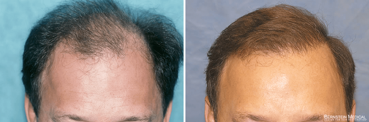 Bernstein Medical - Patient IGI Before and After Hair Transplant Photo 