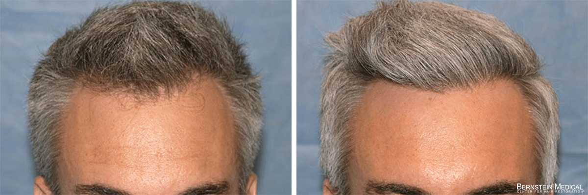 Bernstein Medical - Patient IKR Before and After Hair Transplant Photo 