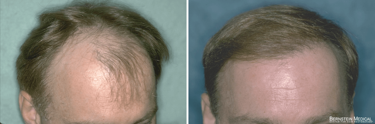 Bernstein Medical - Patient IOF Before and After Hair Transplant Photo 
