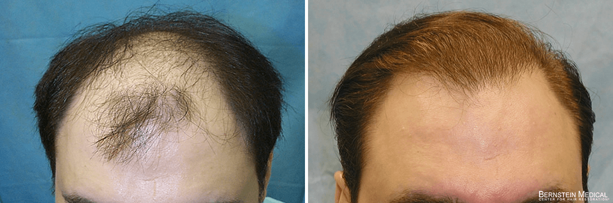 Bernstein Medical - Patient IPS Before and After Hair Transplant Photo 