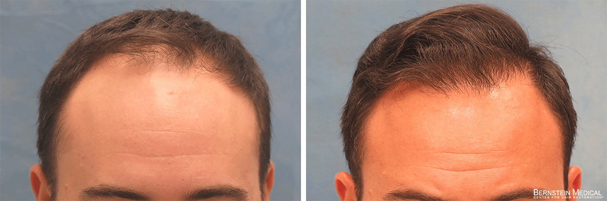 Bernstein Medical - Patient JBZ Before and After Hair Transplant Photo 