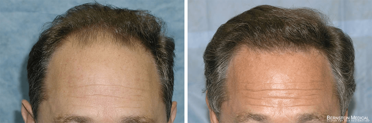 Bernstein Medical - Patient JFQ Before and After Hair Transplant Photo 