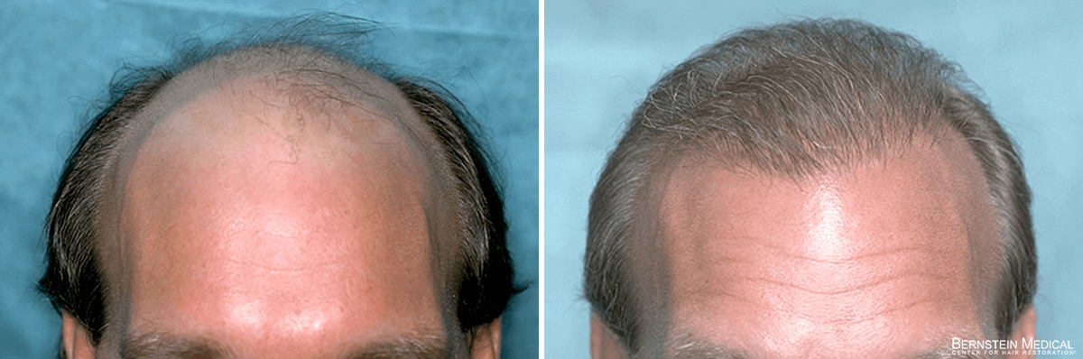 Bernstein Medical - Patient JQD Before and After Hair Transplant Photo 