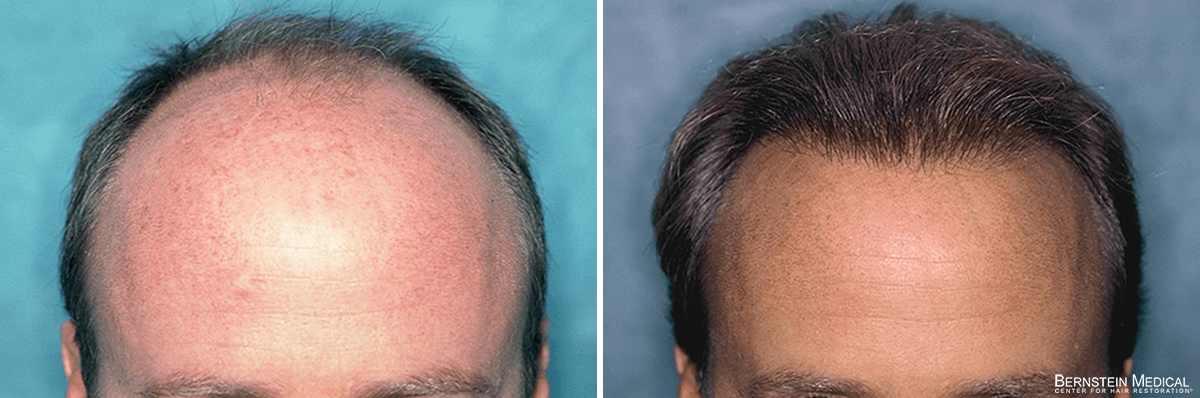Bernstein Medical - Patient JRQ Before and After Hair Transplant Photo 