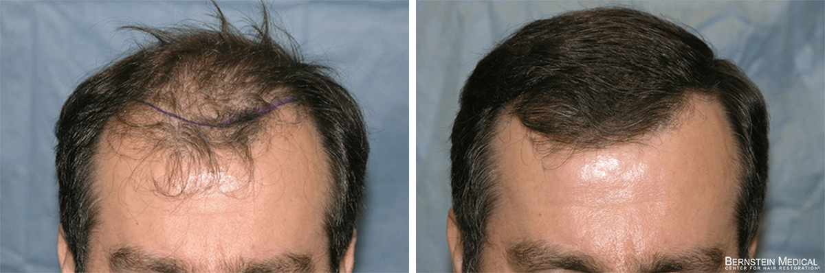 Bernstein Medical - Patient JSI Before and After Hair Transplant Photo 