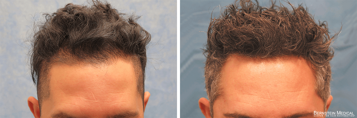 Bernstein Medical - Patient JUO Before and After Hair Transplant Photo 