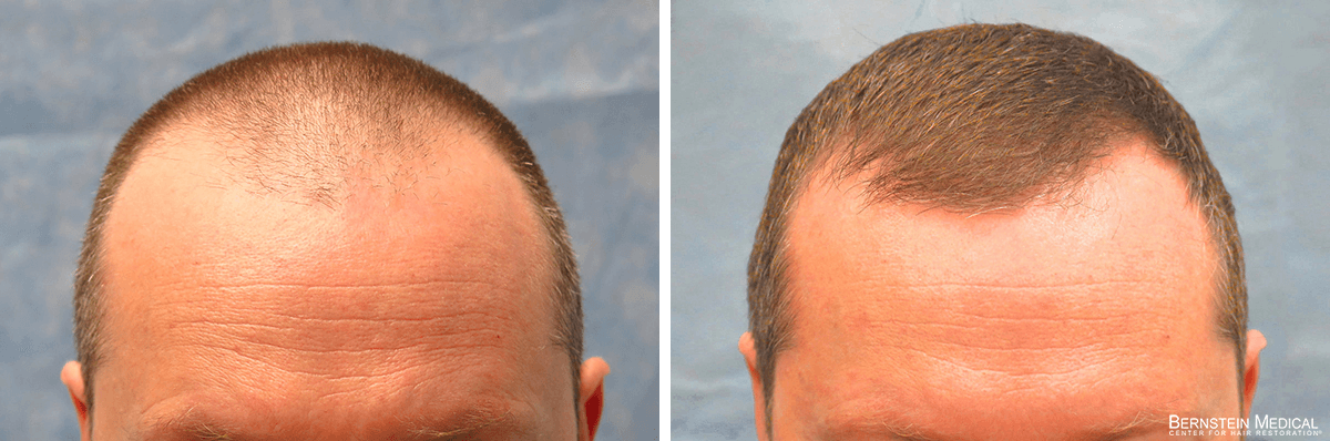Bernstein Medical - Patient JVK Before and After Hair Transplant Photo