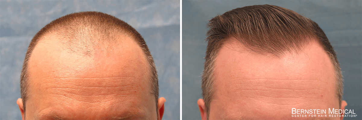 Bernstein Medical - Patient JVK Before and After Hair Transplant Photo 