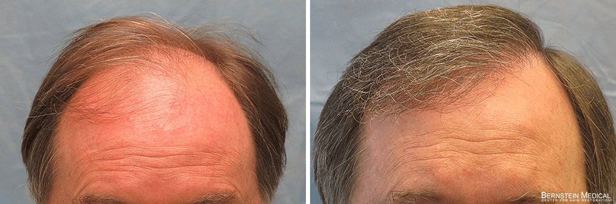 Bernstein Medical - Patient KLJ Before and After Hair Transplant Photo 