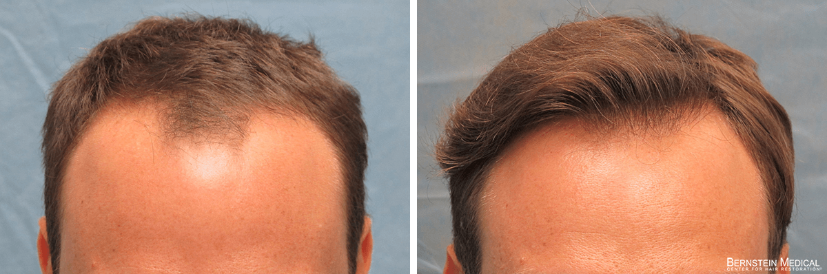 Bernstein Medical - Patient KRQ Before and After Hair Transplant Photo 