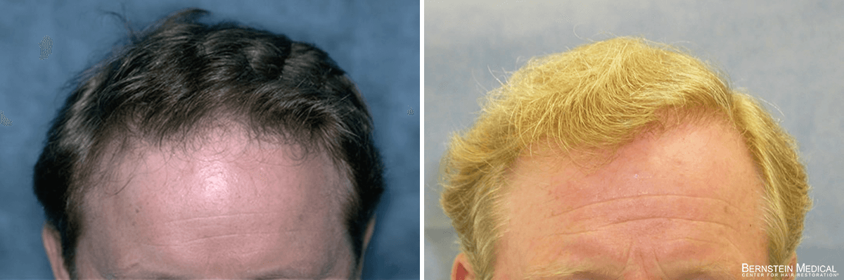 Bernstein Medical - Patient KSO Before and After Hair Transplant Photo 