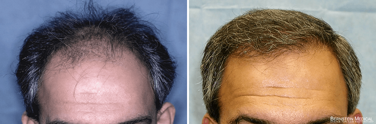 Bernstein Medical - Patient LAR Before and After Hair Transplant Photo