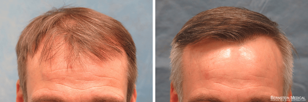 Bernstein Medical - Patient LKI Before and After Hair Transplant Photo 