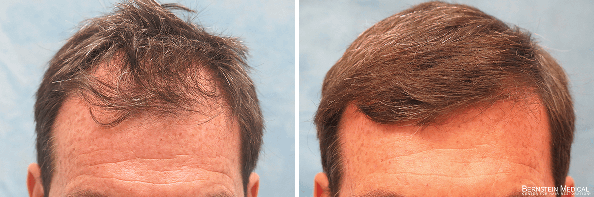 Bernstein Medical - Patient LRL Before and After Hair Transplant Photo 