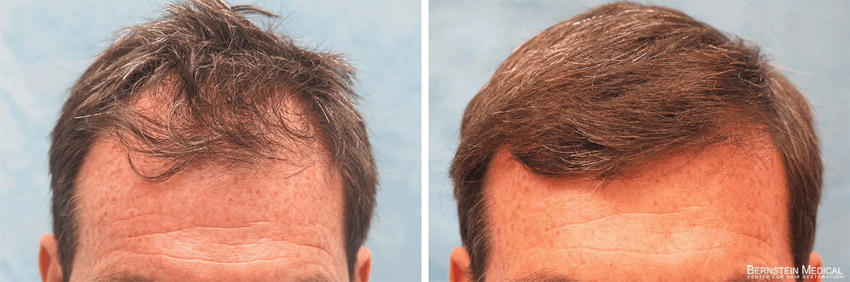 Bernstein Medical - Patient LRL Before and After Hair Transplant Photo