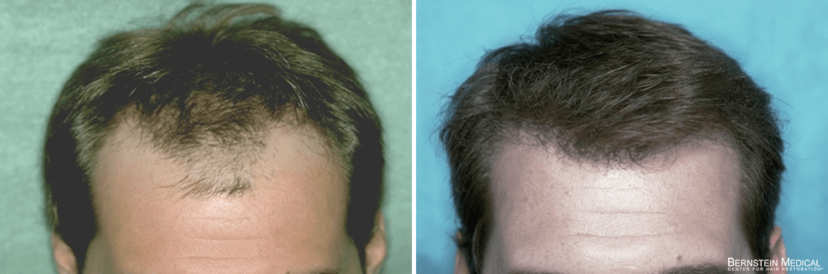 Bernstein Medical - Patient LWJ Before and After Hair Transplant Photo 