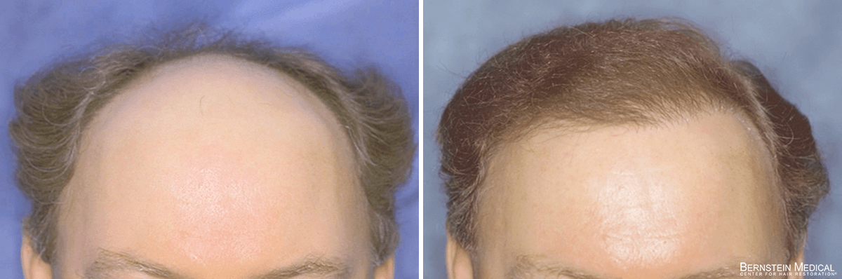 Bernstein Medical - Patient LXI Before and After Hair Transplant Photo 