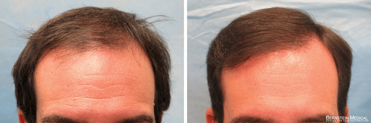 Bernstein Medical - Patient LYL Before and After Hair Transplant Photo 