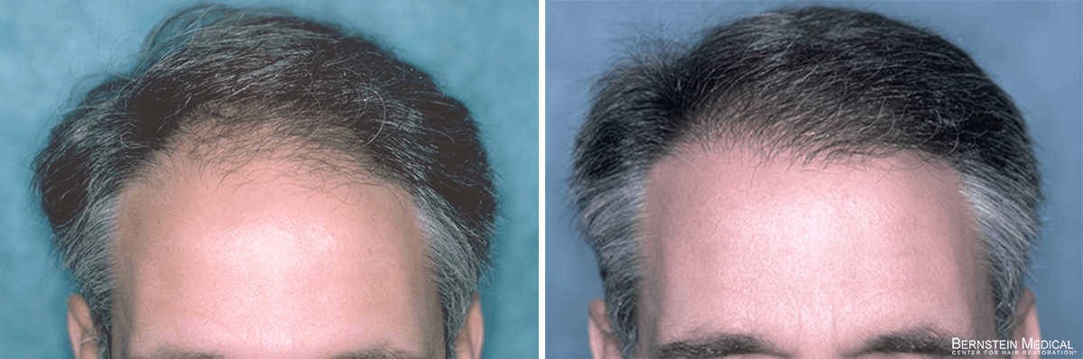 Bernstein Medical - Patient LZB Before and After Hair Transplant Photo 