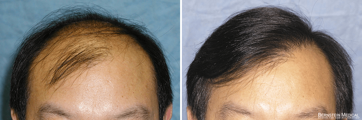 Bernstein Medical - Patient MBZ Before and After Hair Transplant Photo 