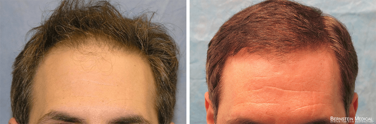Bernstein Medical - Patient MVL Before and After Hair Transplant Photo 