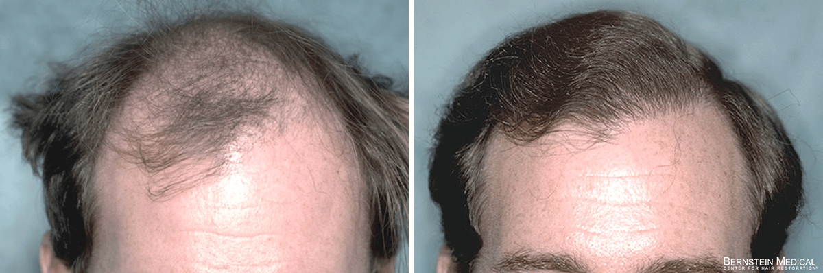 Bernstein Medical - Patient NEI Before and After Hair Transplant Photo 