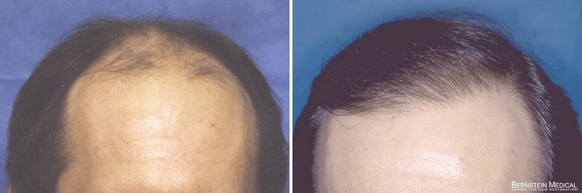 Bernstein Medical - Patient NFZ Before and After Hair Transplant Photo 