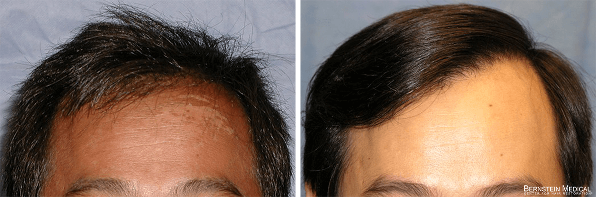 Bernstein Medical - Patient NSG Before and After Hair Transplant Photo