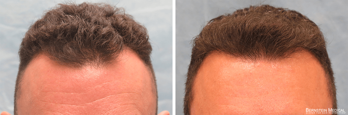 Bernstein Medical - Patient ODO Before and After Hair Transplant Photo 