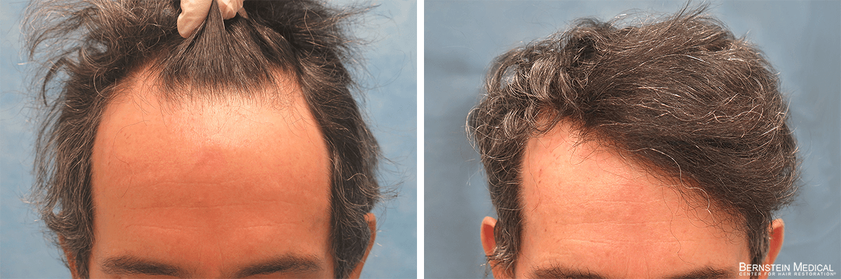 Bernstein Medical - Patient OVX Before and After Hair Transplant Photo 