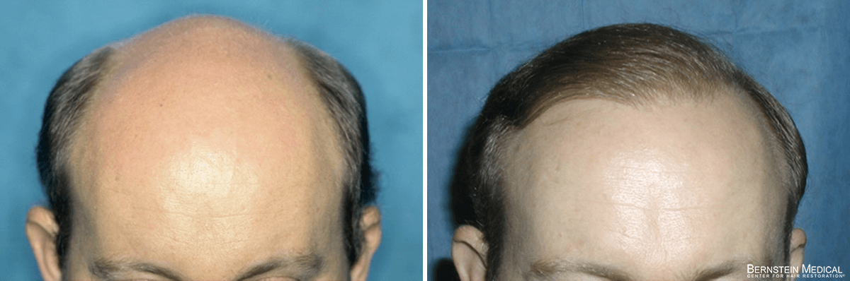 Bernstein Medical - Patient QGA Before and After Hair Transplant Photo 