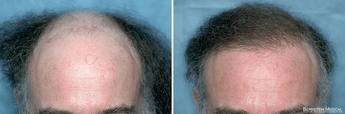 Bernstein Medical - Patient QHB Before and After Hair Transplant Photo 