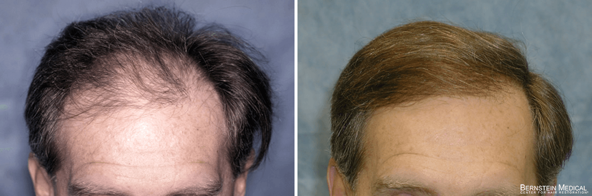 Bernstein Medical - Patient QIA Before and After Hair Transplant Photo 