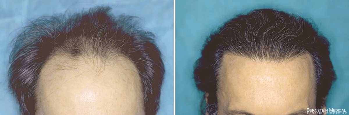 Bernstein Medical - Patient QJS Before and After Hair Transplant Photo