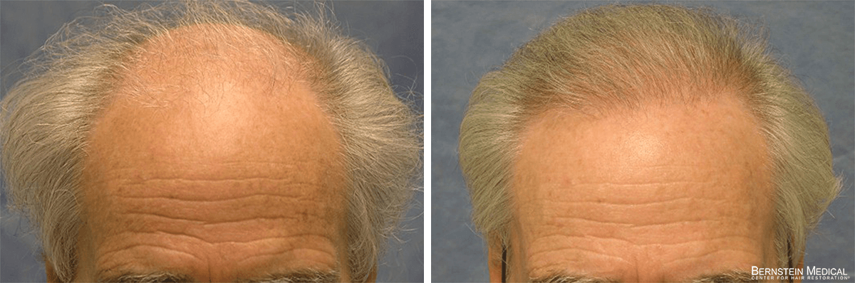 Bernstein Medical - Patient QLA Before and After Hair Transplant Photo 